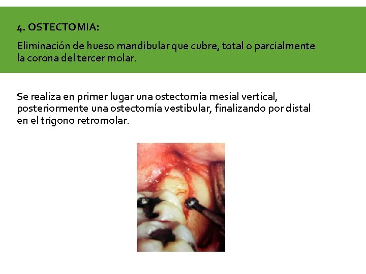 4. OSTECTOMIA: Eliminación de hueso mandibular que cubre, total o parcialmente la corona del