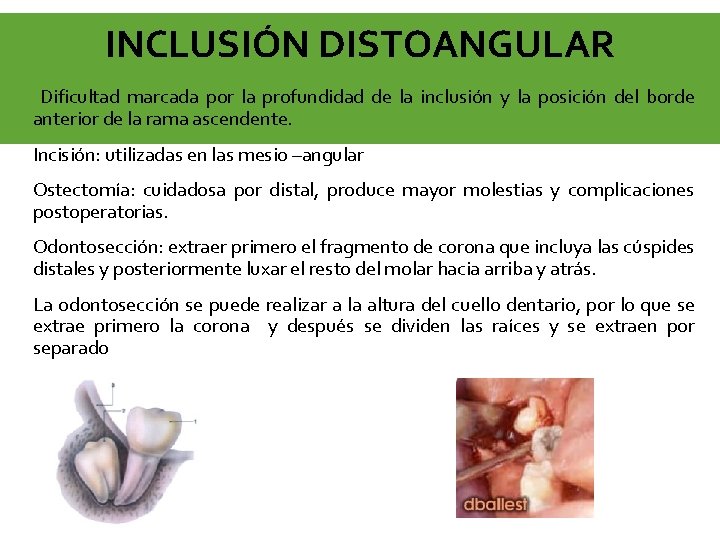 INCLUSIÓN DISTOANGULAR Dificultad marcada por la profundidad de la inclusión y la posición del