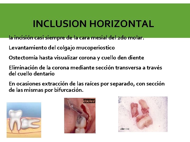 INCLUSION HORIZONTAL la incisión casi siempre de la cara mesial del 2 do molar.