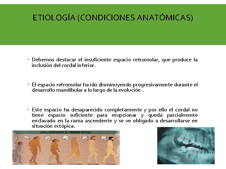 ETIOLOGÍA (CONDICIONES ANATÓMICAS) Debemos destacar el insuficiente espacio retromolar, que produce la inclusión del