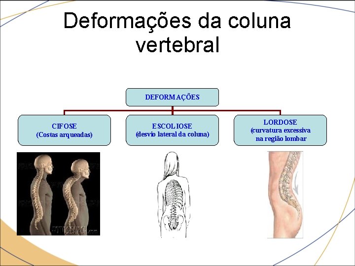 Deformações da coluna vertebral DEFORMAÇÕES CIFOSE (Costas arqueadas) ESCOLIOSE (desvio lateral da coluna) LORDOSE