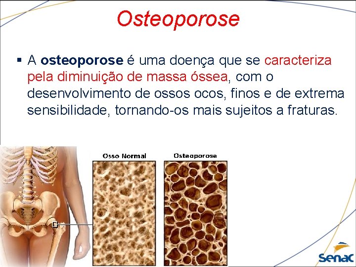 Osteoporose § A osteoporose é uma doença que se caracteriza pela diminuição de massa