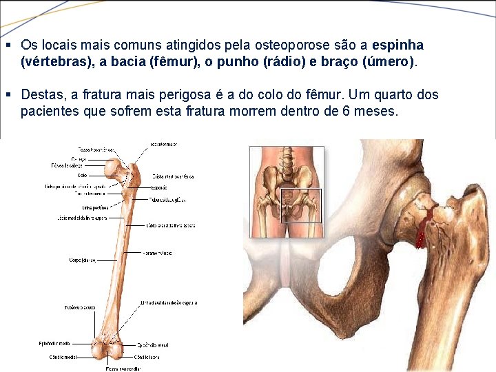 § Os locais mais comuns atingidos pela osteoporose são a espinha (vértebras), a bacia