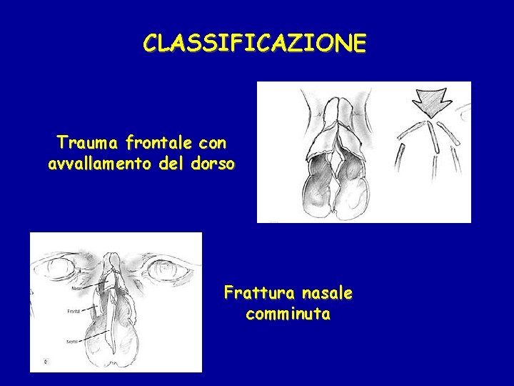 CLASSIFICAZIONE Trauma frontale con avvallamento del dorso Frattura nasale comminuta 