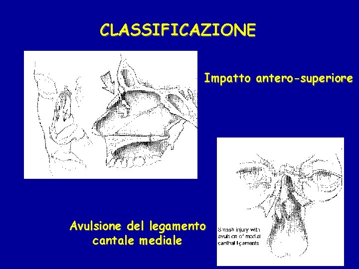 CLASSIFICAZIONE Impatto antero-superiore Avulsione del legamento cantale mediale 