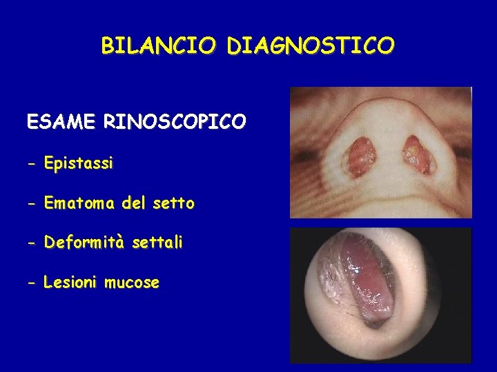 BILANCIO DIAGNOSTICO ESAME RINOSCOPICO - Epistassi - Ematoma del setto - Deformità settali -