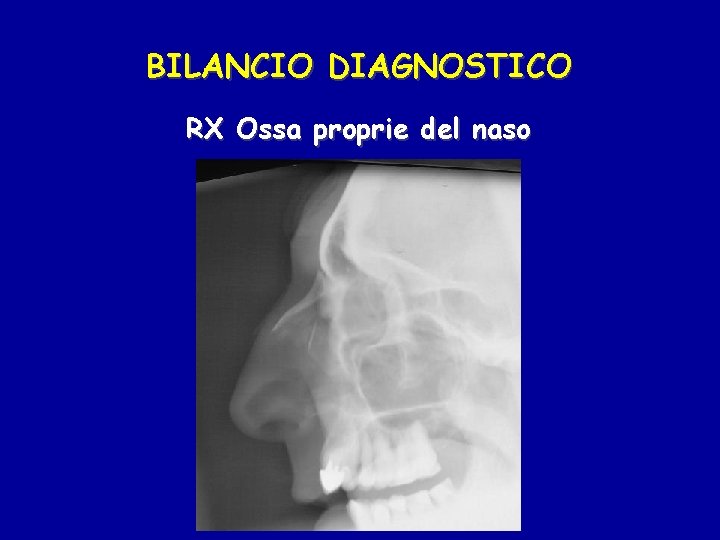 BILANCIO DIAGNOSTICO RX Ossa proprie del naso 