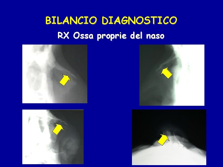 BILANCIO DIAGNOSTICO RX Ossa proprie del naso 