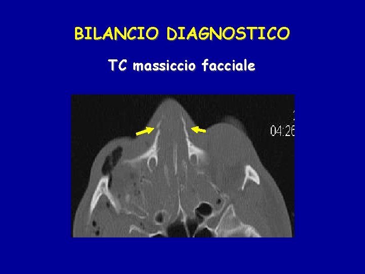 BILANCIO DIAGNOSTICO TC massiccio facciale 