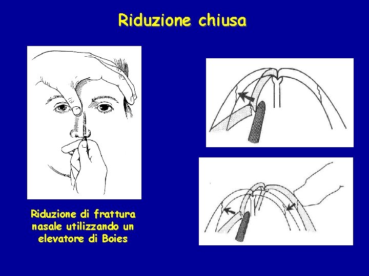 Riduzione chiusa Riduzione di frattura nasale utilizzando un elevatore di Boies 