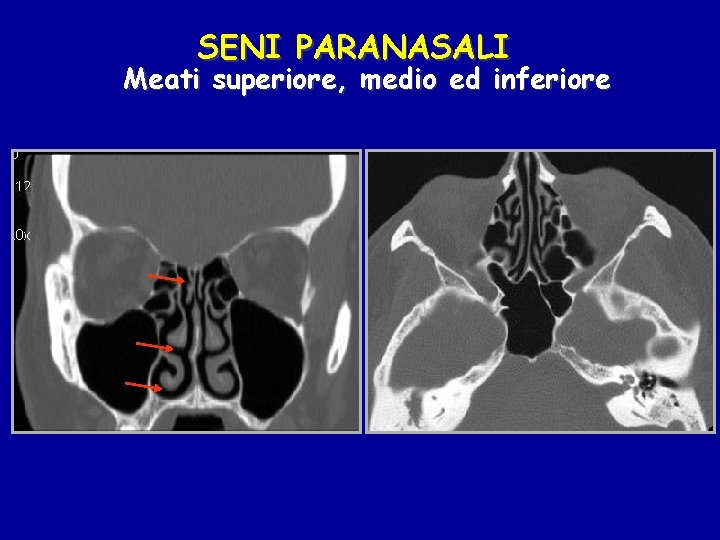 SENI PARANASALI Meati superiore, medio ed inferiore 