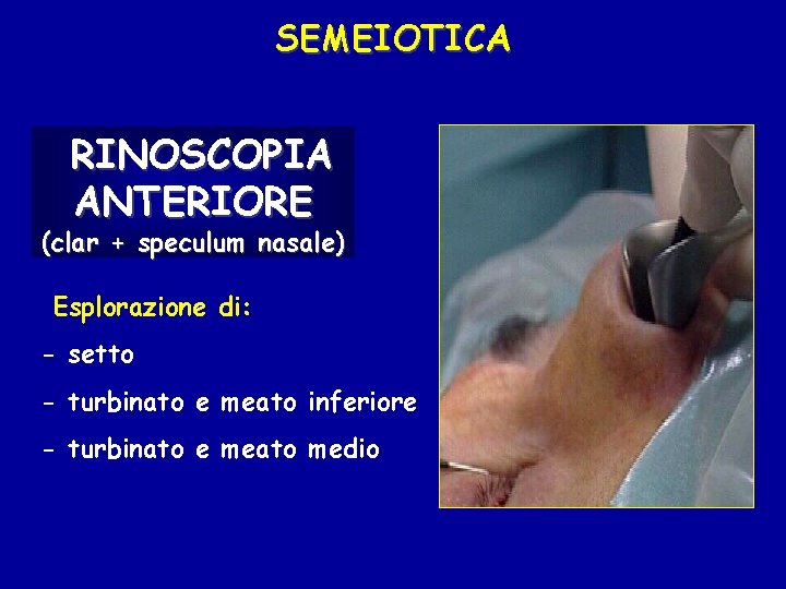 SEMEIOTICA RINOSCOPIA ANTERIORE (clar + speculum nasale) Esplorazione di: - setto - turbinato e