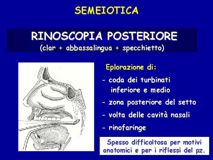 SEMEIOTICA RINOSCOPIA POSTERIORE (clar + abbassalingua + specchietto) Eplorazione di: - coda dei turbinati