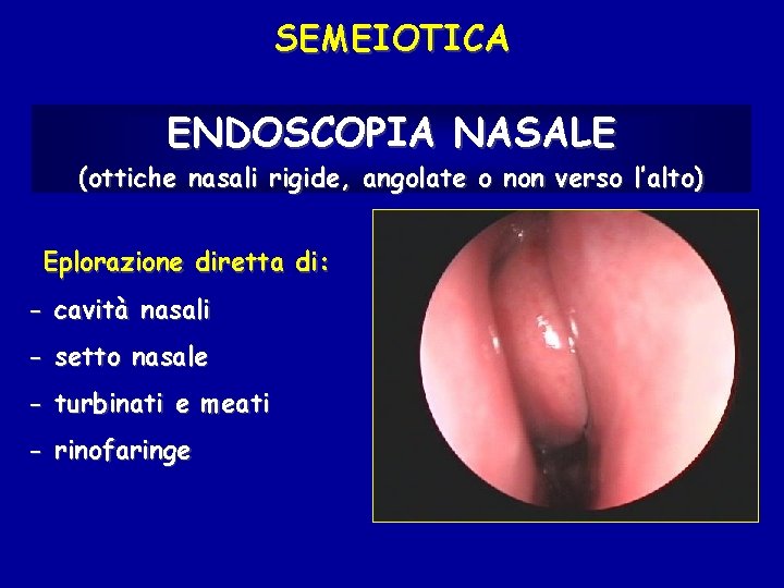 SEMEIOTICA ENDOSCOPIA NASALE (ottiche nasali rigide, angolate o non verso l’alto) Eplorazione diretta di: