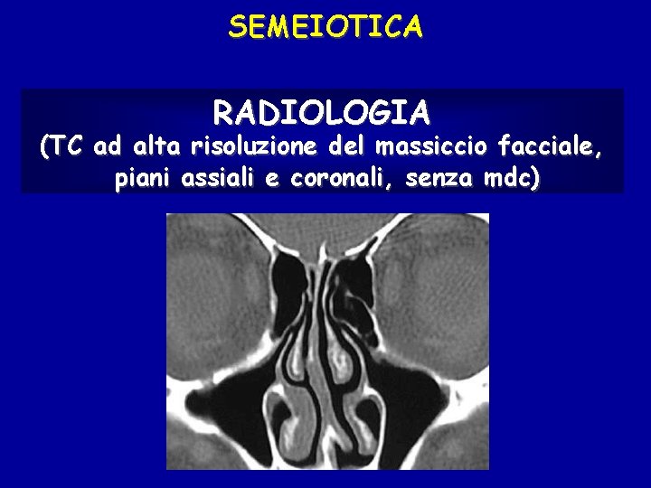 SEMEIOTICA RADIOLOGIA (TC ad alta risoluzione del massiccio facciale, piani assiali e coronali, senza