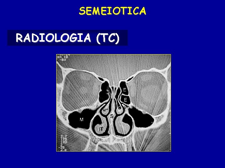 SEMEIOTICA RADIOLOGIA (TC) 