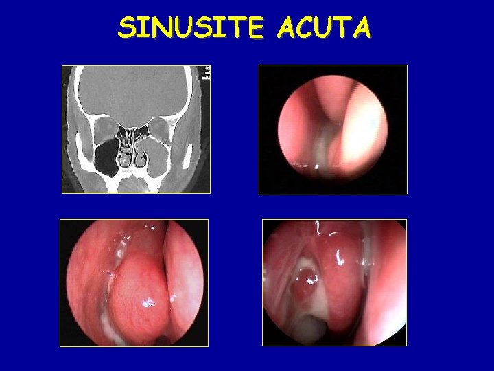 SINUSITE ACUTA 