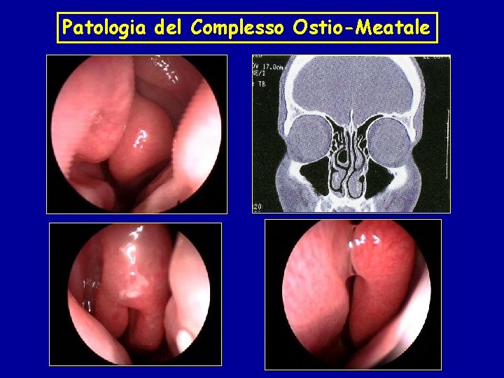 Patologia del Complesso Ostio-Meatale 