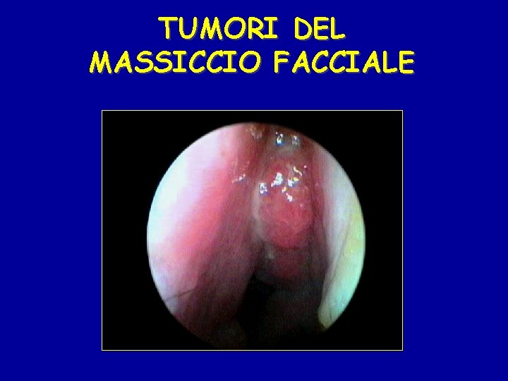 TUMORI DEL MASSICCIO FACCIALE 