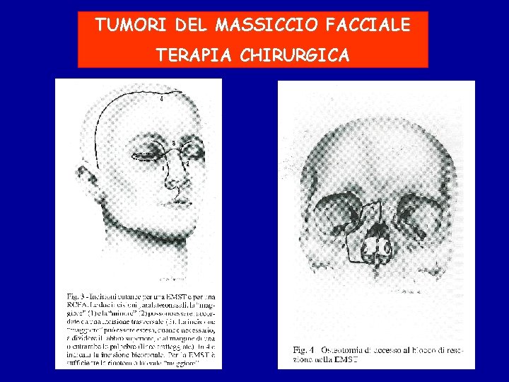 TUMORI DEL MASSICCIO FACCIALE TERAPIA CHIRURGICA 