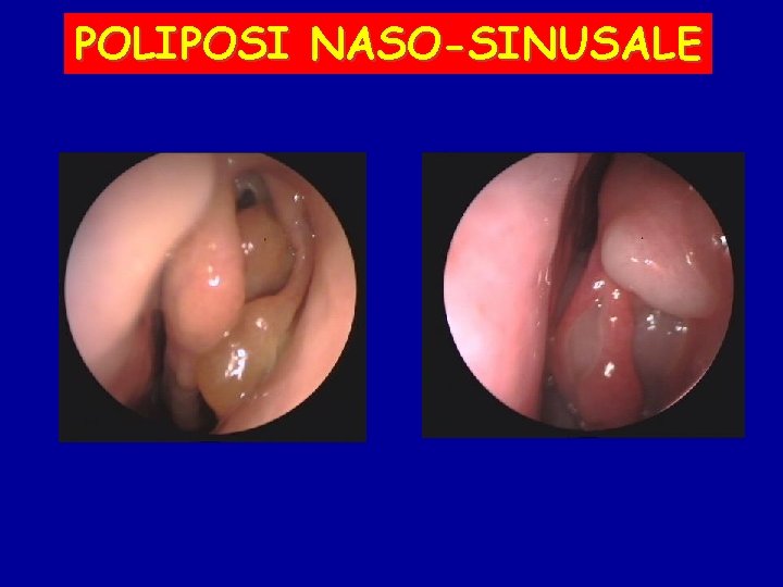 POLIPOSI NASO-SINUSALE 