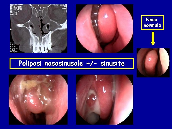 Naso normale Poliposi nasosinusale +/- sinusite 
