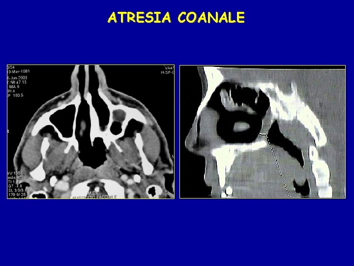 ATRESIA COANALE 