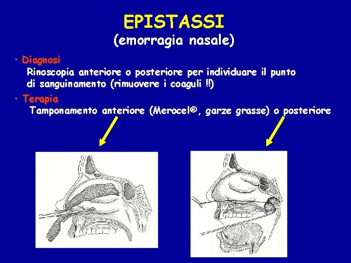 EPISTASSI (emorragia nasale) • Diagnosi Rinoscopia anteriore o posteriore per individuare il punto di