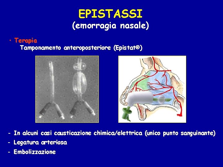 EPISTASSI (emorragia nasale) • Terapia Tamponamento anteroposteriore (Epistat®) - In alcuni casi causticazione chimica/elettrica