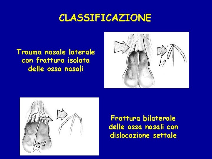 CLASSIFICAZIONE Trauma nasale laterale con frattura isolata delle ossa nasali Frattura bilaterale delle ossa