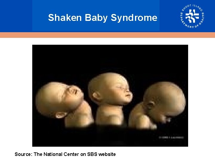 Shaken Baby Syndrome Source: The National Center on SBS website 