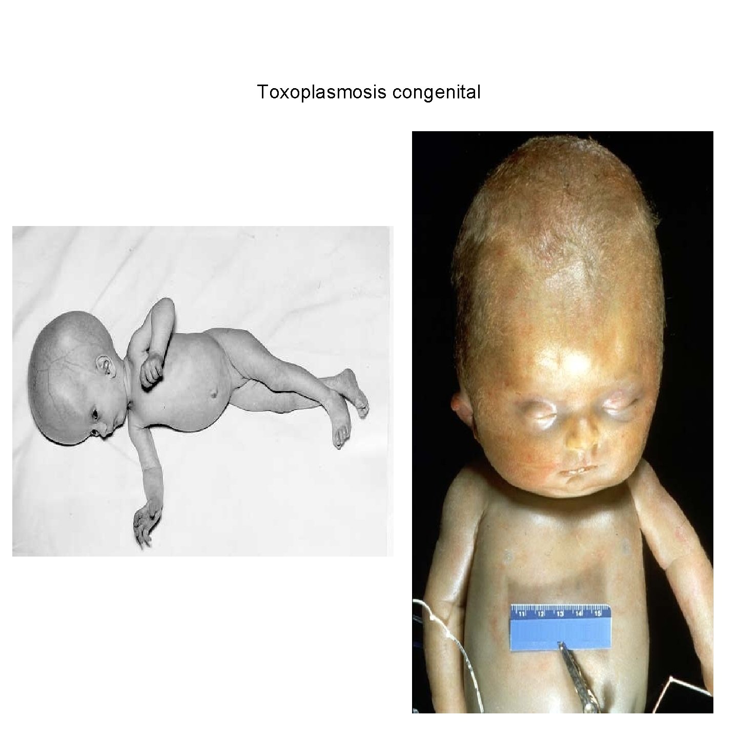 Toxoplasmosis congenital 37 