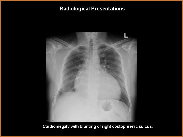 Radiological Presentations Cardiomegaly with blunting of right costophrenic sulcus. 