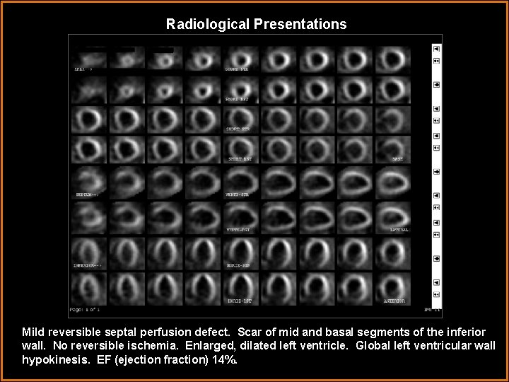 Radiological Presentations Mild reversible septal perfusion defect. Scar of mid and basal segments of