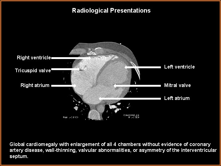 Radiological Presentations Right ventricle Tricuspid valve Right atrium Left ventricle Mitral valve Left atrium