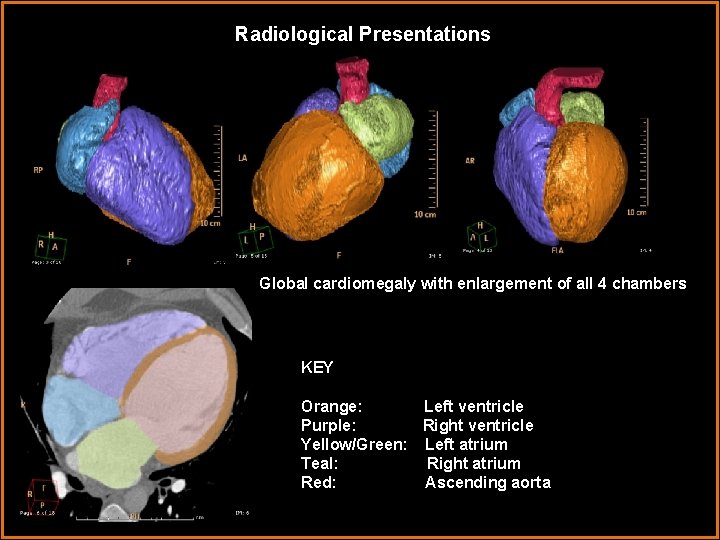 Radiological Presentations Global cardiomegaly with enlargement of all 4 chambers KEY Orange: Left ventricle