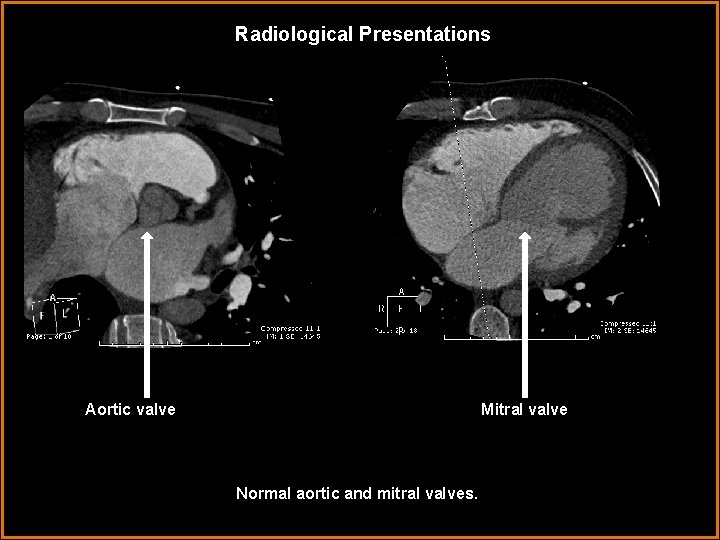 Radiological Presentations Aortic valve Mitral valve Normal aortic and mitral valves. 