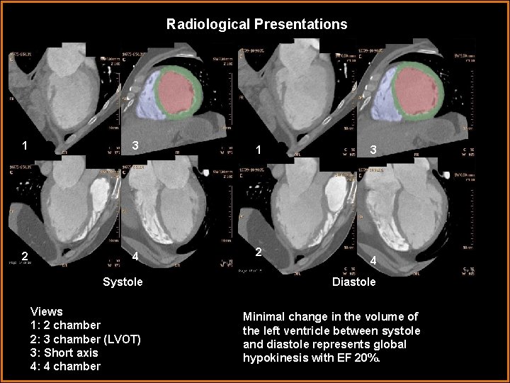 Radiological Presentations 1 3 1 2 4 2 Systole Views 1: 2 chamber 2: