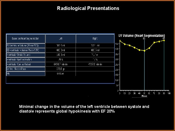 Radiological Presentations Minimal change in the volume of the left ventricle between systole and