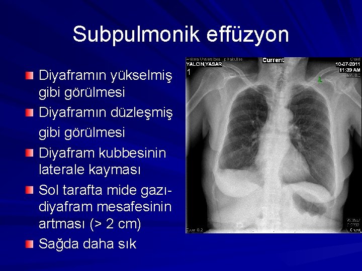 Subpulmonik effüzyon Diyaframın yükselmiş gibi görülmesi Diyaframın düzleşmiş gibi görülmesi Diyafram kubbesinin laterale kayması