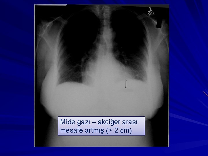 Mide gazı – akciğer arası mesafe artmış (> 2 cm) 