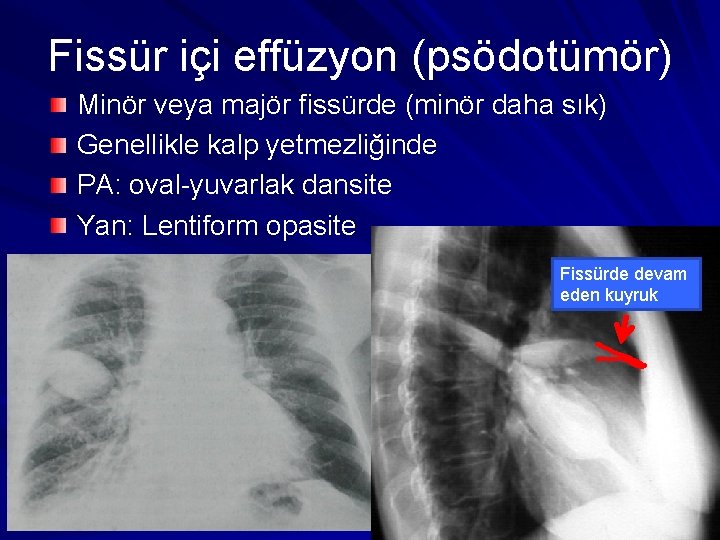 Fissür içi effüzyon (psödotümör) Minör veya majör fissürde (minör daha sık) Genellikle kalp yetmezliğinde