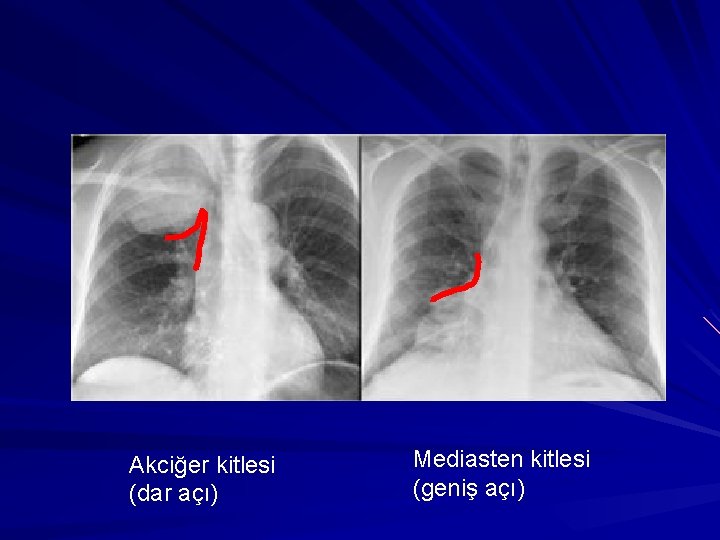 Akciğer kitlesi (dar açı) Mediasten kitlesi (geniş açı) 