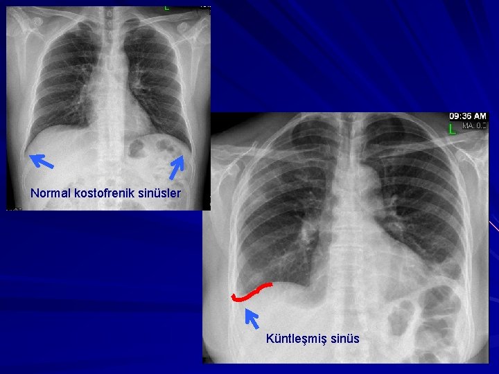 Normal kostofrenik sinüsler Küntleşmiş sinüs 