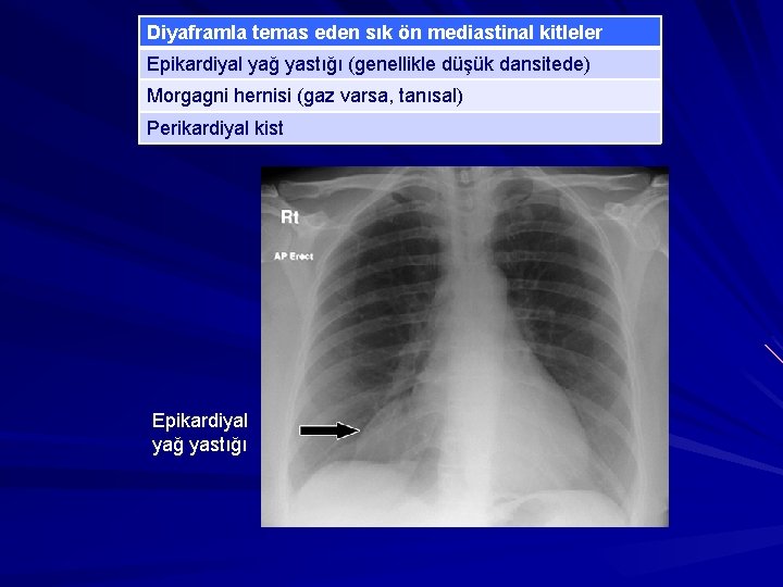 Diyaframla temas eden sık ön mediastinal kitleler Epikardiyal yağ yastığı (genellikle düşük dansitede) Morgagni