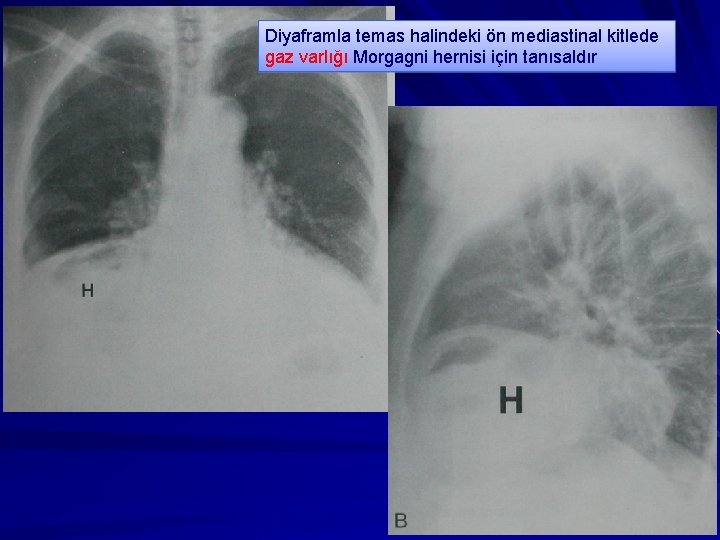 Diyaframla temas halindeki ön mediastinal kitlede gaz varlığı Morgagni hernisi için tanısaldır 