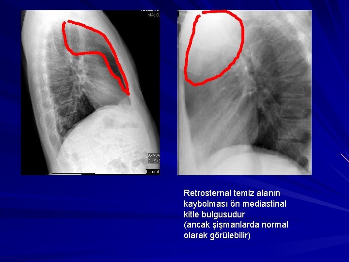 Retrosternal temiz alanın kaybolması ön mediastinal kitle bulgusudur (ancak şişmanlarda normal olarak görülebilir) 