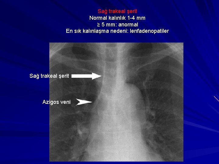 Sağ trakeal şerit Normal kalınlık 1 -4 mm ≥ 5 mm: anormal En sık