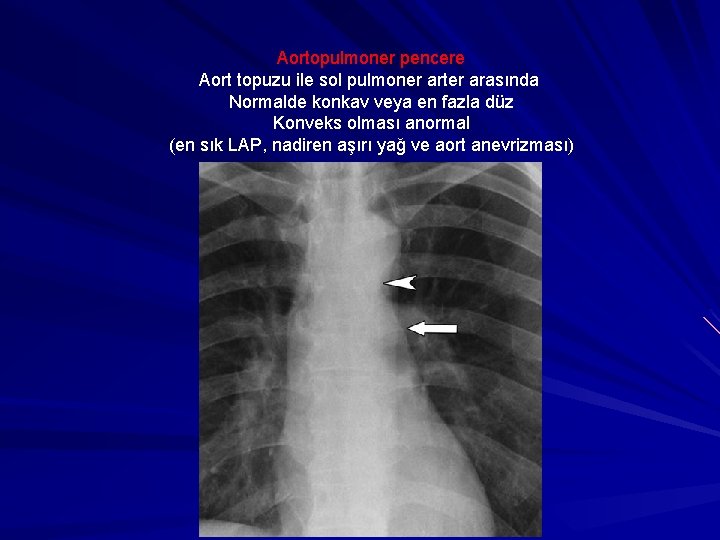 Aortopulmoner pencere Aort topuzu ile sol pulmoner arter arasında Normalde konkav veya en fazla