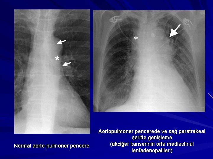 Normal aorto-pulmoner pencere Aortopulmoner pencerede ve sağ paratrakeal şeritte genişleme (akciğer kanserinin orta mediastinal
